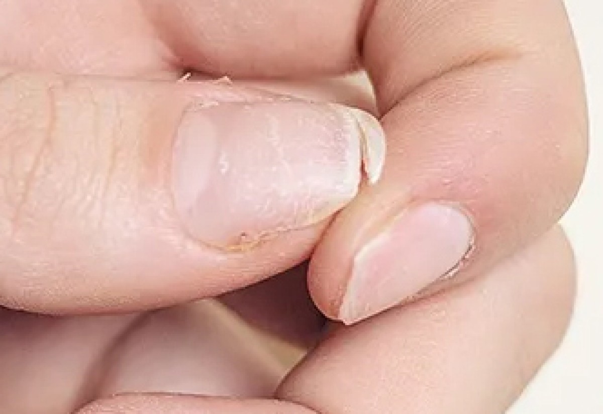 Dırnaqların sınması