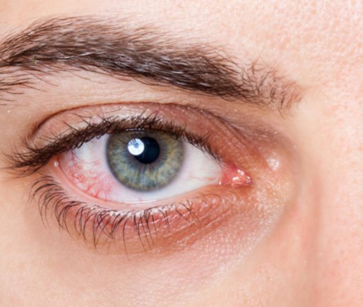 Gözlərin qızarması