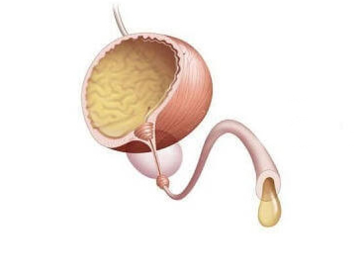 Uretrit